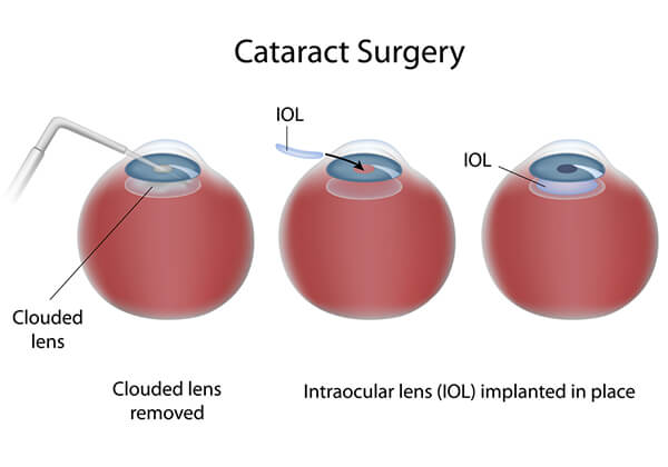 Cataract Surgery Cleveland