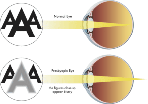 Normal vs Presyopia eye
