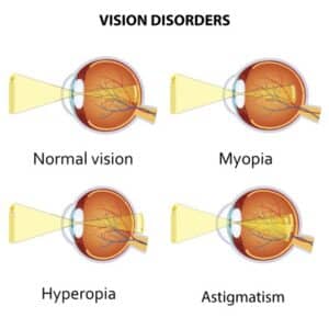 Vision Disorder Diagram