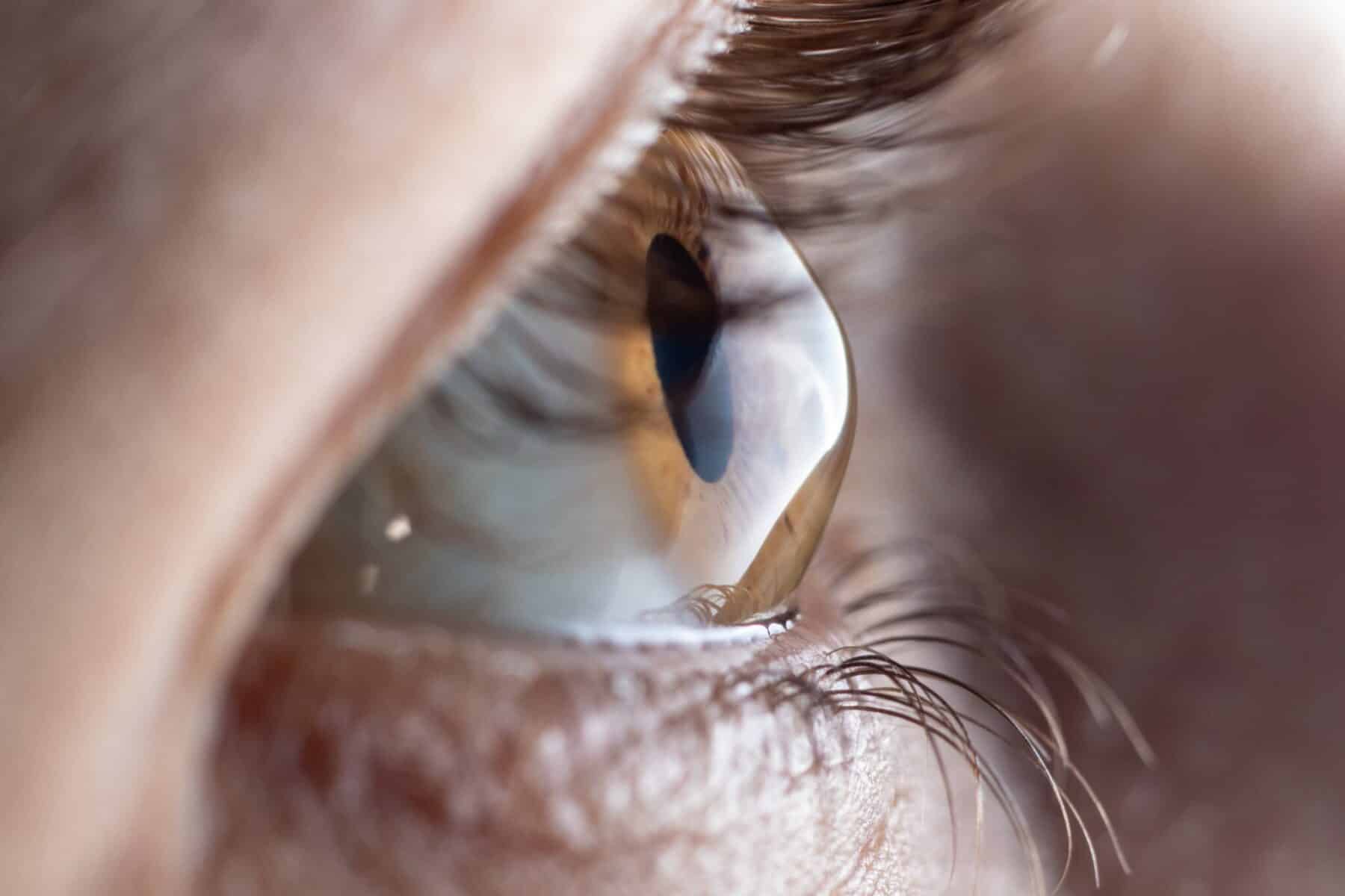 close up of an eye with keratoconus