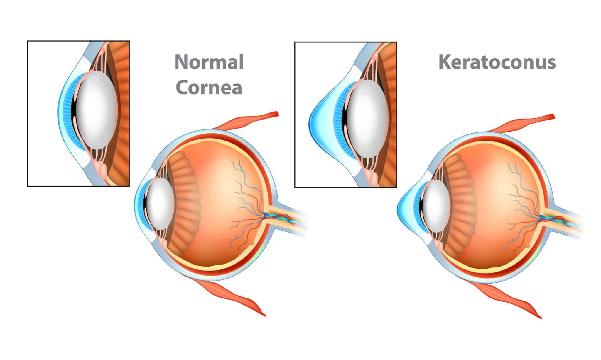 corneal cross linking diagram