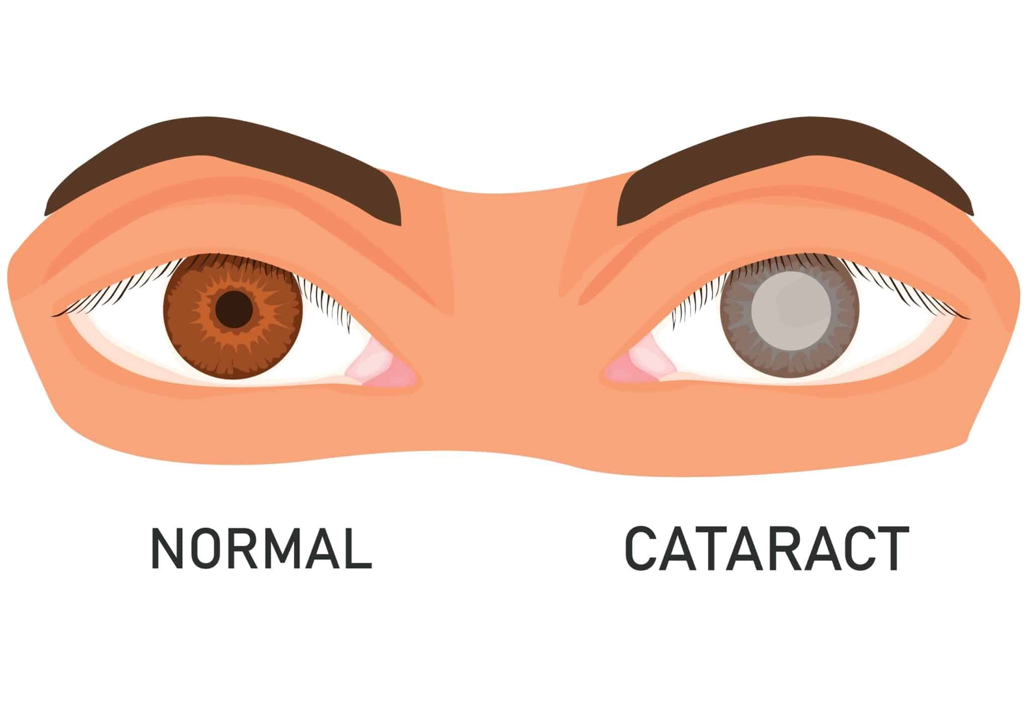 cataract diagram