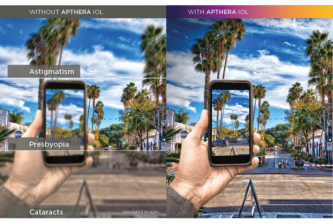 before and after apthera